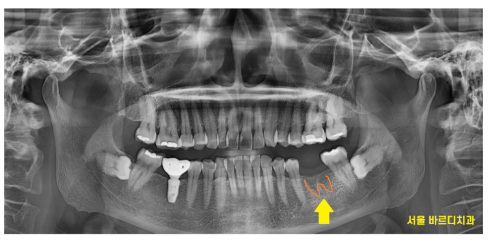 고덕역 근처 치과 임플란트 크라운 크기 크면 다 좋을까요?? 관련 이미지 3