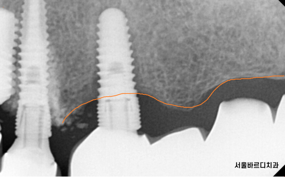둔촌동 치과 임플란트 평균 수명 이것이 진짜 진실입니다 관련 이미지 3