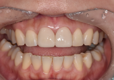 강일역 치과, 검게 보이는 앞니 레진 변색, 무조건 새로 해야 할까요? 관련 이미지 13