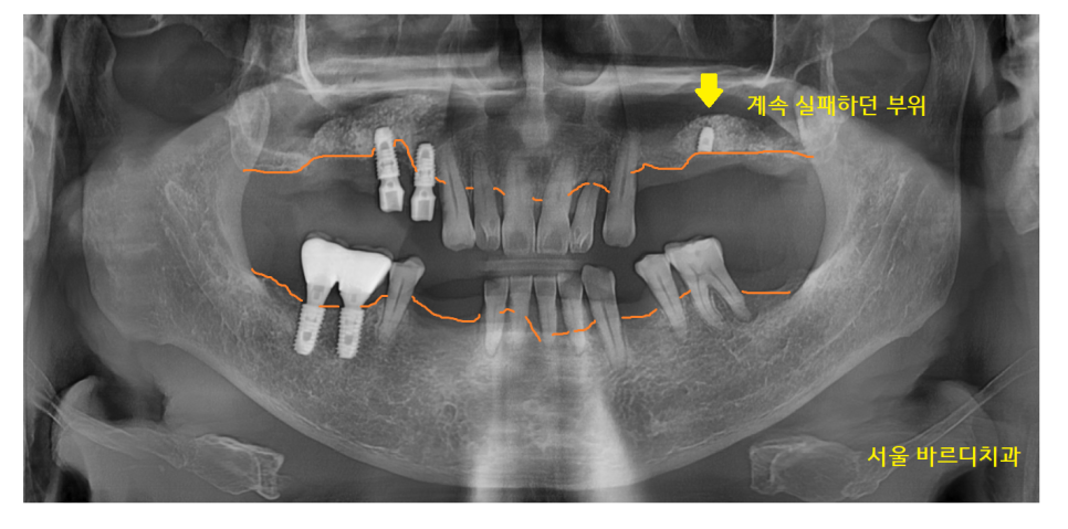 하남시청치과 디지털 임플란트를 고집하는 이유 관련 이미지 2