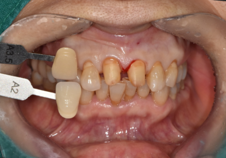 대문니 파절, 앞니에 금이 쩍 갈라졌다면? 딱딱한 음식을 조심해야 하는 이유 관련 이미지 12