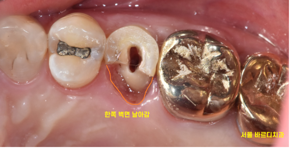 초이동 치과 치아 실금으로 조각나 신경치료까지 진행했습니다. 관련 이미지 6