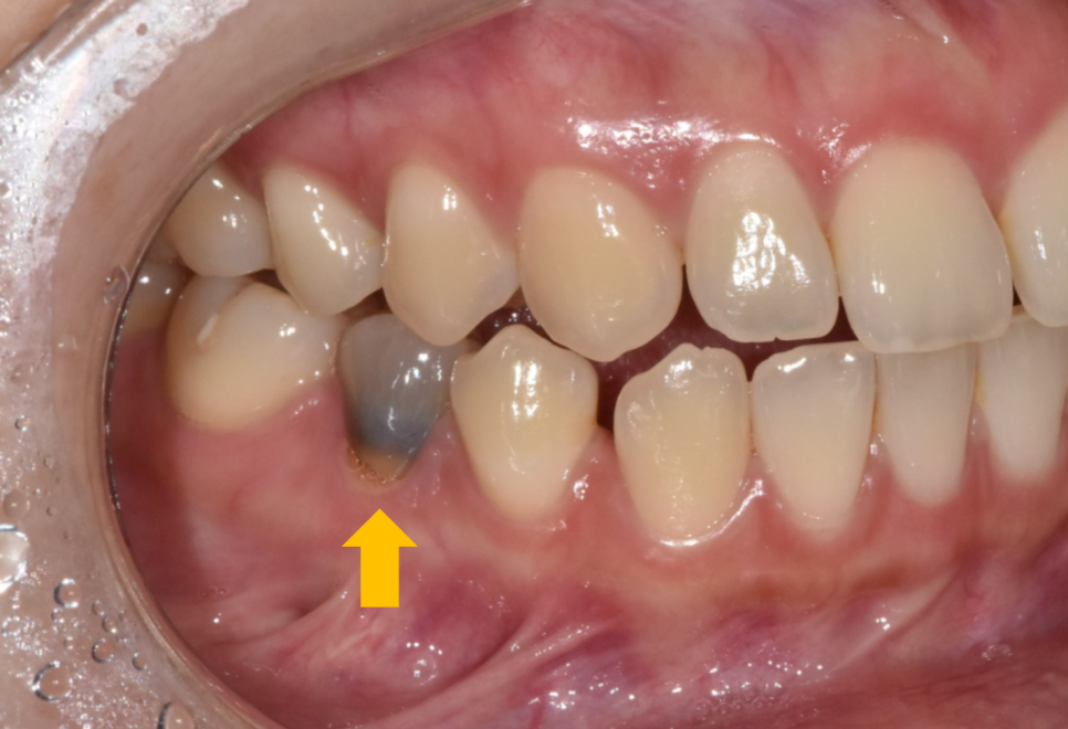 치아 멍 까맣게 변했어요 변색되고 괴사되었을 때 대처법 공개 관련 이미지 2