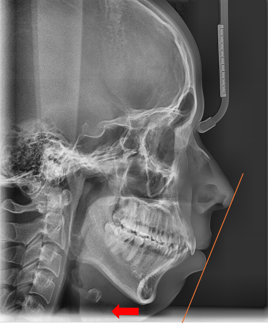 Adult Chin Correction: It Can Go Beyond Appearance Issues and Even Disturb You During Sleep image 1