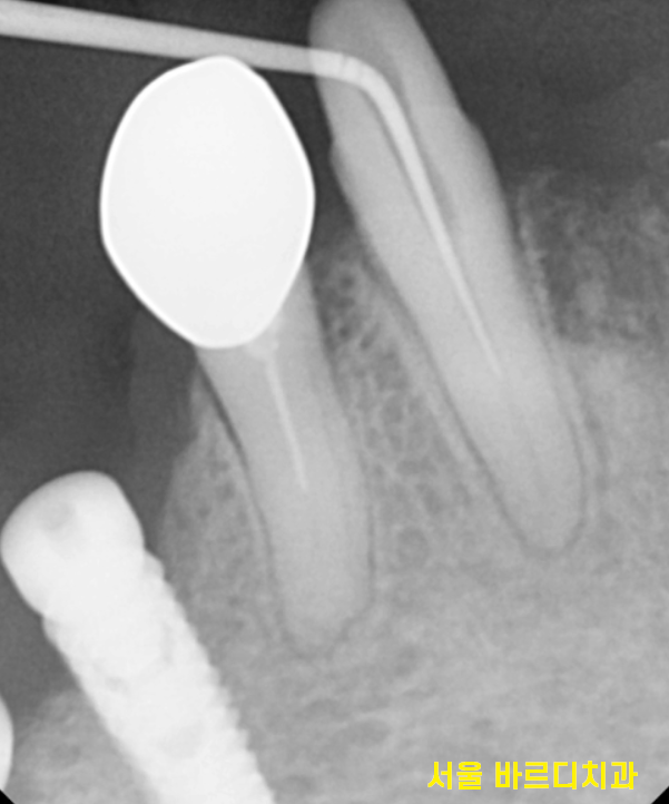 길동 치과 임플란트 틀니 차이 세세하게 대공개 관련 이미지 6