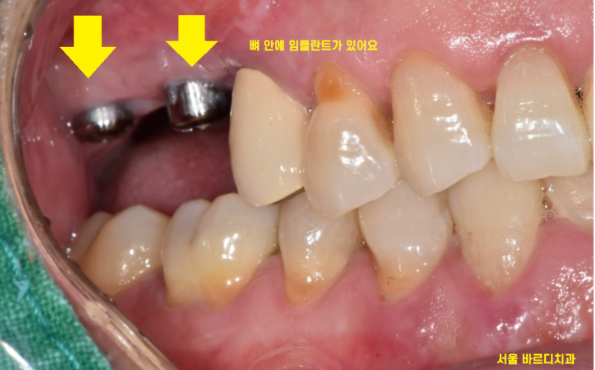 상일동역 치과에서 알려드리는 임플란트 수술과정 대공개 관련 이미지 6