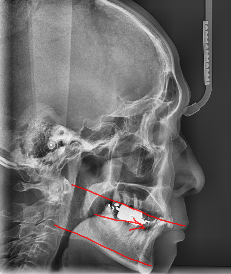 교정과 임플란트 동시에 해야한다면? 순서는? 관련 이미지 4