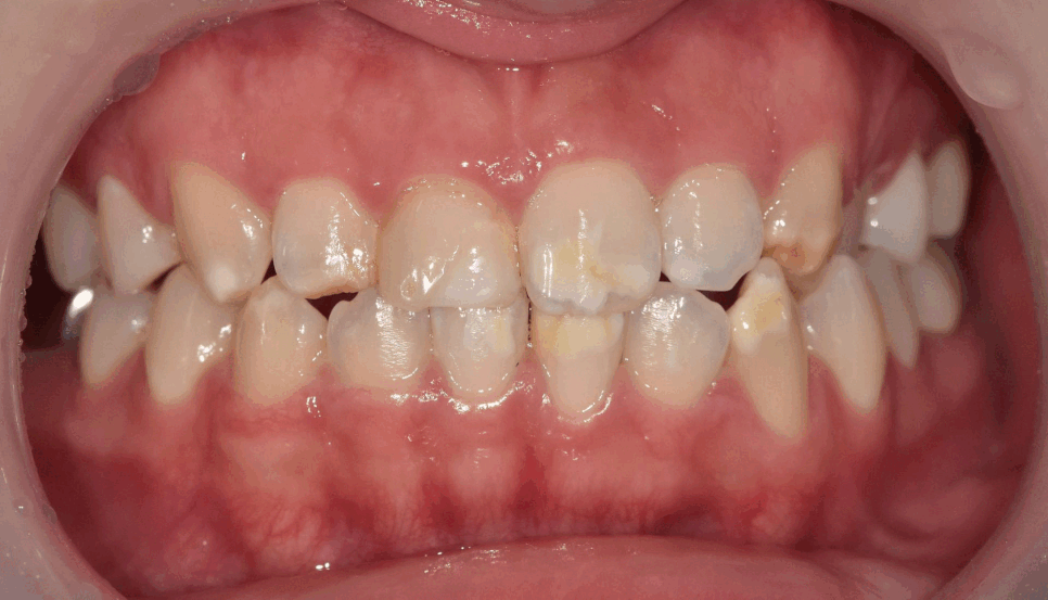 강동구 라미네이트, 치아 하얀 반점 없애고 싶다면? 치료 방법 관련 이미지 13