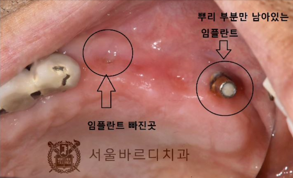 상일동역치과 서울바르디치과 무절개 네비게이션 임플란트 치료증례 #5 관련 이미지 9