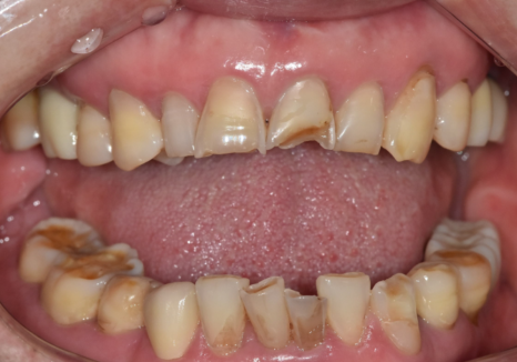 Gangdong-gu Dental Impressions: Are You Still Biting Down for 5 Minutes? We’ll Make It Comfortable with an Intraoral Scanner! image 8