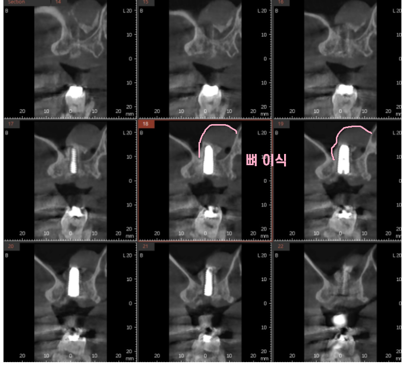 강동구 임플란트 뿌리 염증 심해질경우 대처 방법 관련 이미지 6