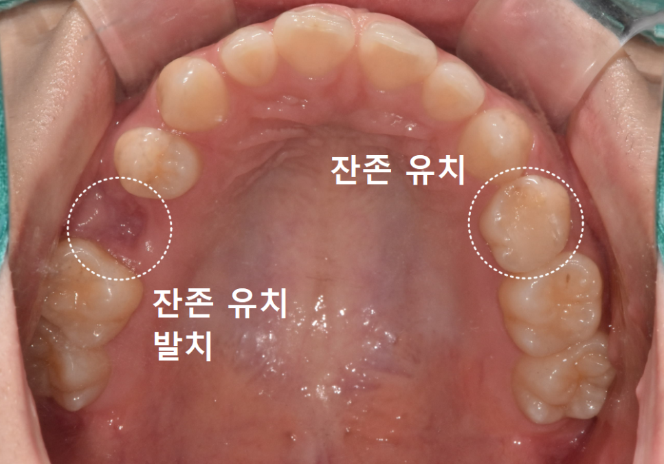 얇은 잇몸뼈 때문에 임플란트 하기 힘들다면? 저희는 관련 이미지 3
