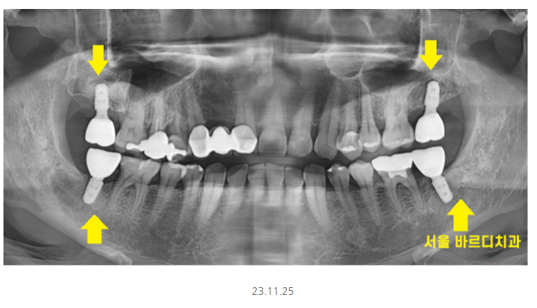 명일동 치과 임플란트 위아래 같이 할 수 있나요?? 관련 이미지 7