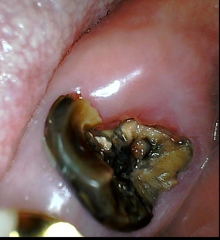 바르디 임플란트는 바르게 심지만, 빠르게 씹습니다. 그간의 경험을 바탕으로요. 관련 이미지 5