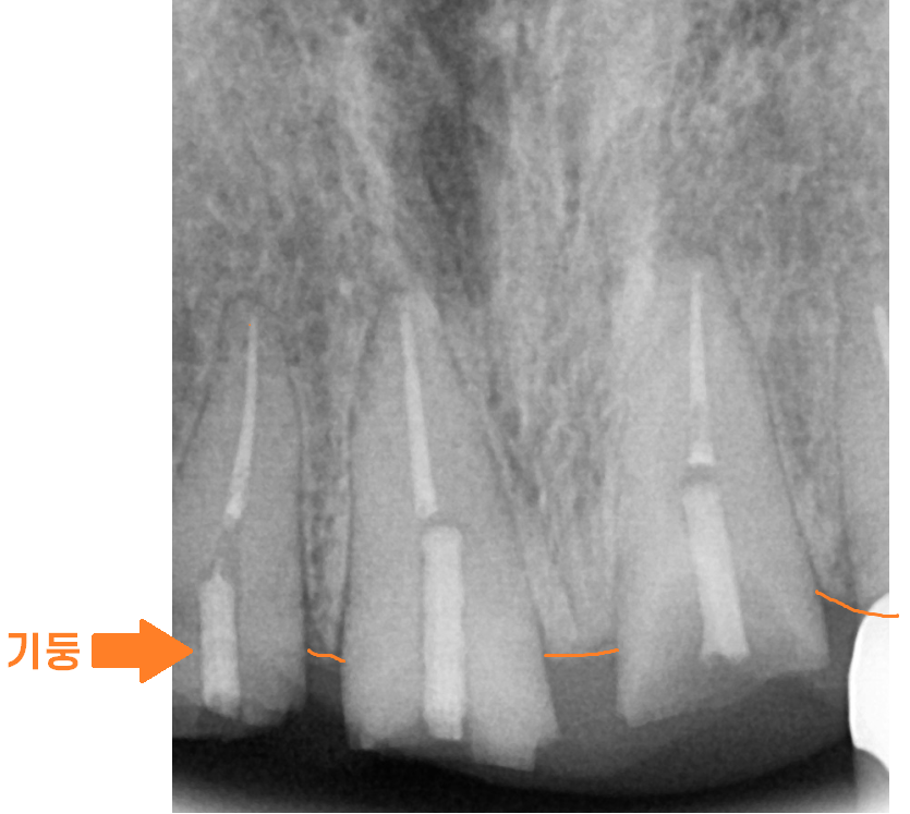상일동역 치과 부러진 앞니 임플란트로 복구하기 프로젝트 관련 이미지 3