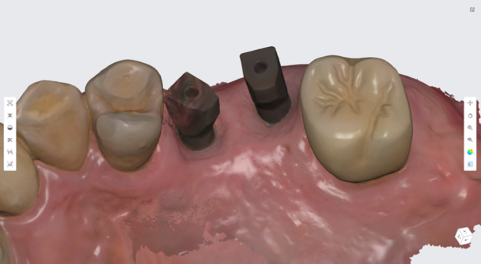 고덕동치과 서울바르디치과 전치부 및 구치부 임플란트 치료증례 #9 관련 이미지 32