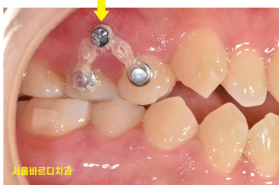 교정중 미니스크류 필수일까? 투명교정도 때로는 필요하다 관련 이미지 2