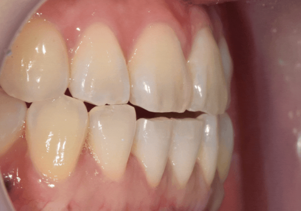 앞니 라미네이트, 치아 시림 고민 덜 수 있는 해결 방법 공개합니다. 관련 이미지 10