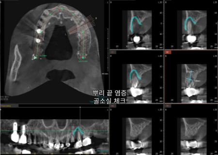 서울바르디치과 뿌리 끝 염증 심한 치아를 네비게이션 임플란트 #6 관련 이미지 7