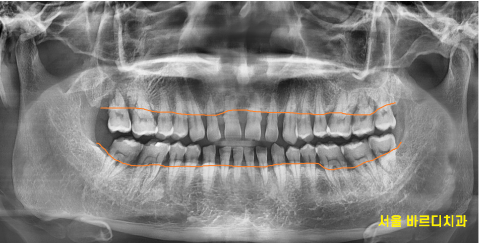 앞니 사이 간격 넓어짐 치아가 벌어져서 보기 싫을 때 크라운 치료 관련 이미지 3