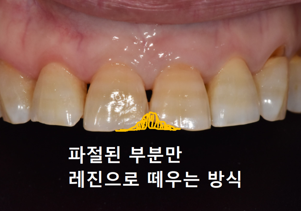 앞니 끝부분 깨짐, 다듬기, 레진, 라미네이트? 어떤 치료가 나에게 적합할까? 관련 이미지 2