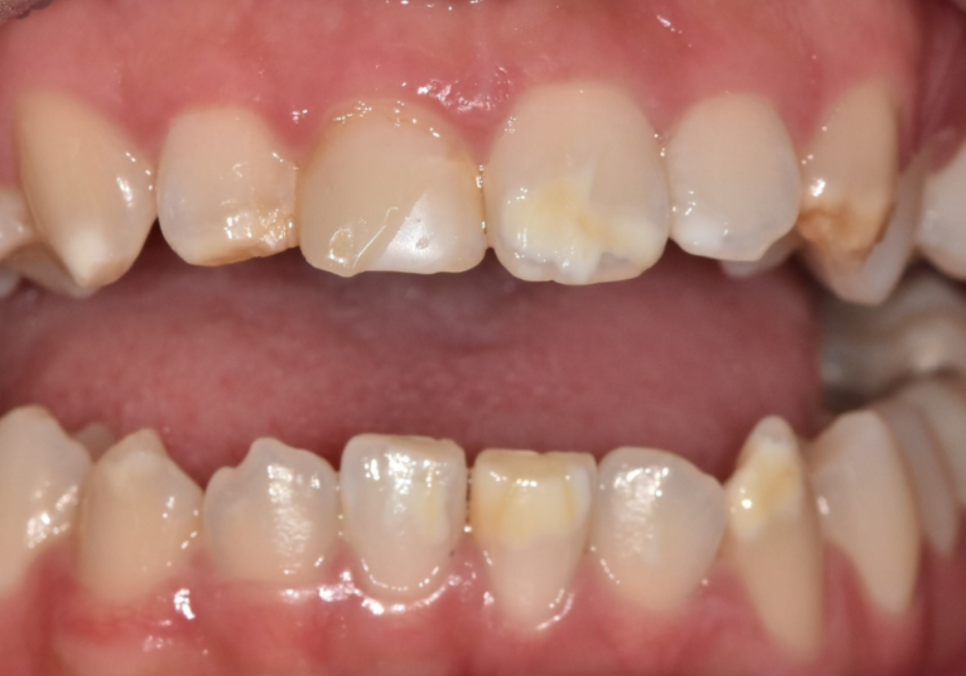 고덕역 치과 반점치 얼룩덜룩한 치아, 치료 실패 줄이는 5가지 기준 관련 이미지 1