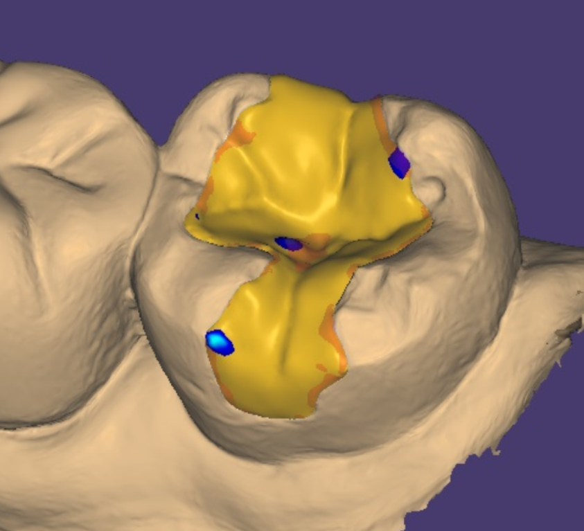 상일동역 임플란트 구강스캐너로 디지털 진료 선두하는 대표 치과입니다! 관련 이미지 9