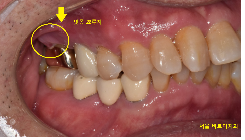 명일역 근처 치과 치아 뿌리 염증이 생겨서 고생하신 사연 관련 이미지 4