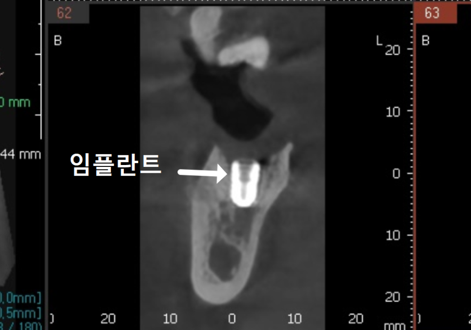 수평 매복 사랑니, 옆으로 누운 사랑니 때문에 멀쩡한 어금니까지 뽑은 사연 관련 이미지 9