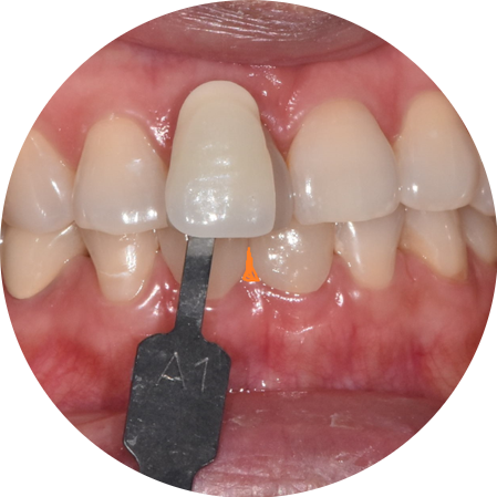 고덕동 치과에서 시행한 라미네이트와 치아 미백 과정 및 순서 관련 이미지 5