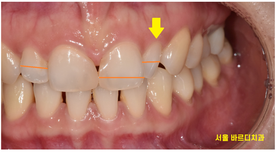 왜소치 라미네이트 작은 치아 콤플렉스 말끔하게 극복해요!! 관련 이미지 2