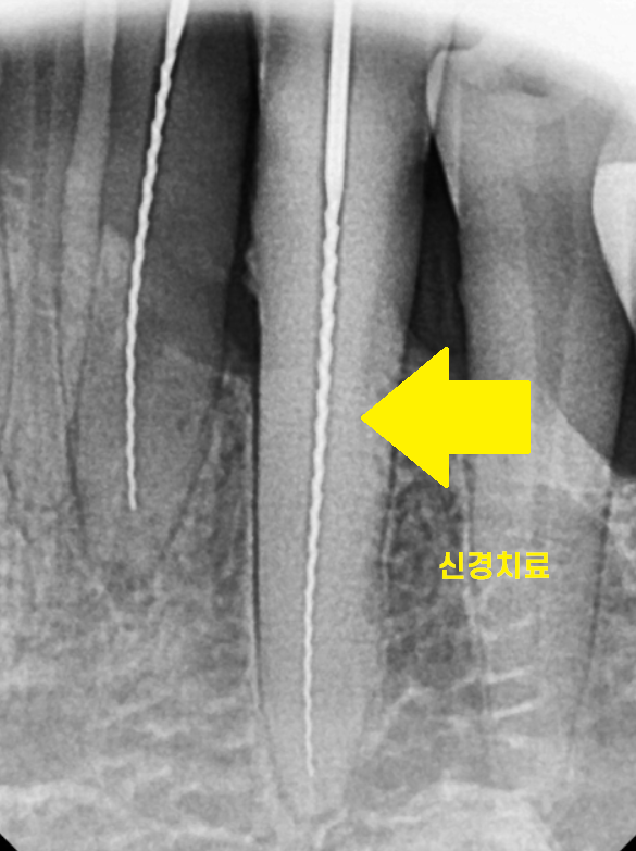 치과 엑스레이 꼭 찍어야하나요? 암사역 치과에서 답변드립니다. 관련 이미지 5