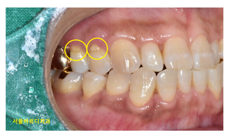 치아 옆면 파임 치경부마모증 치료해주어야하는 이유는? 관련 이미지 6