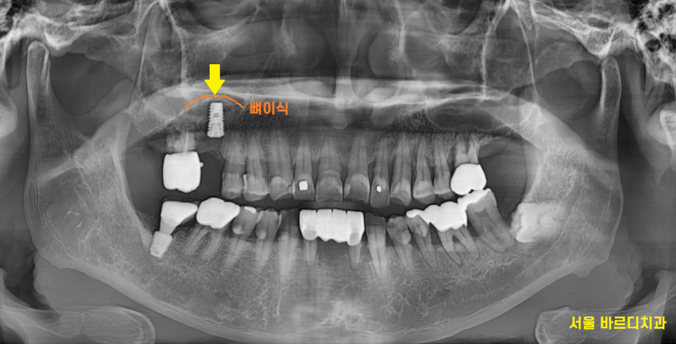 강일동 치과추천 어금니 시림 방치하지마세요 발치하고 임플란트 할 수 있습니다. 관련 이미지 7