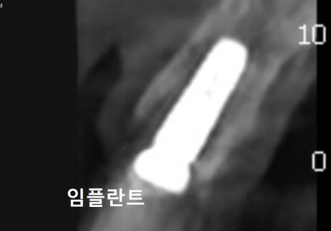 앞니 임플란트, 원내 기공소의 중요성을 아시나요? 관련 이미지 14