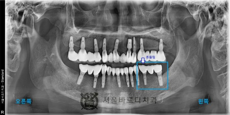 상일동역치과 서울바르디치과 무절개 네비게이션 임플란트 치료증례 #5 관련 이미지 3