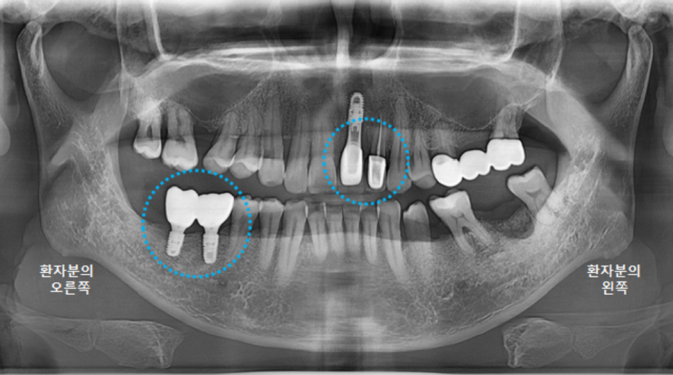 고덕동치과 서울바르디치과 전치부 및 구치부 임플란트 치료증례 #9 관련 이미지 9