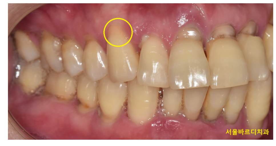 치아 옆면 파임 치경부마모증 치료해주어야하는 이유는? 관련 이미지 3