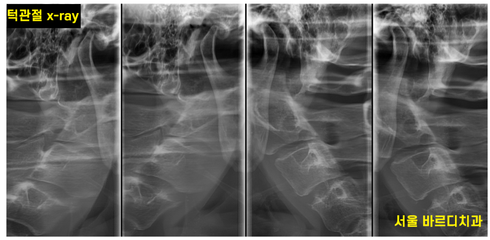 상일동역 턱관절 명절 음식 조심히 드세요!!!! 관련 이미지 6