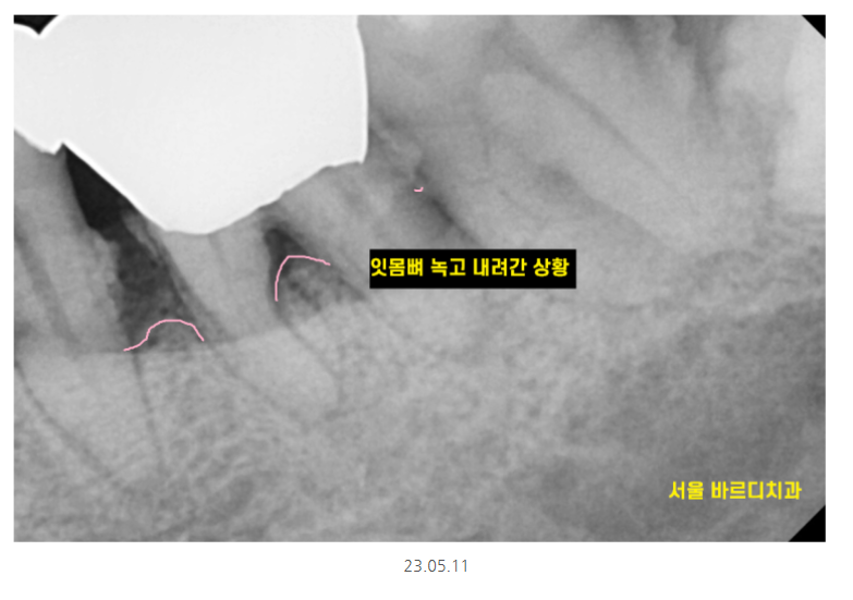 강일동 치과추천 어금니 시림 방치하다 발치하고 임플란트 하신 사연 관련 이미지 5