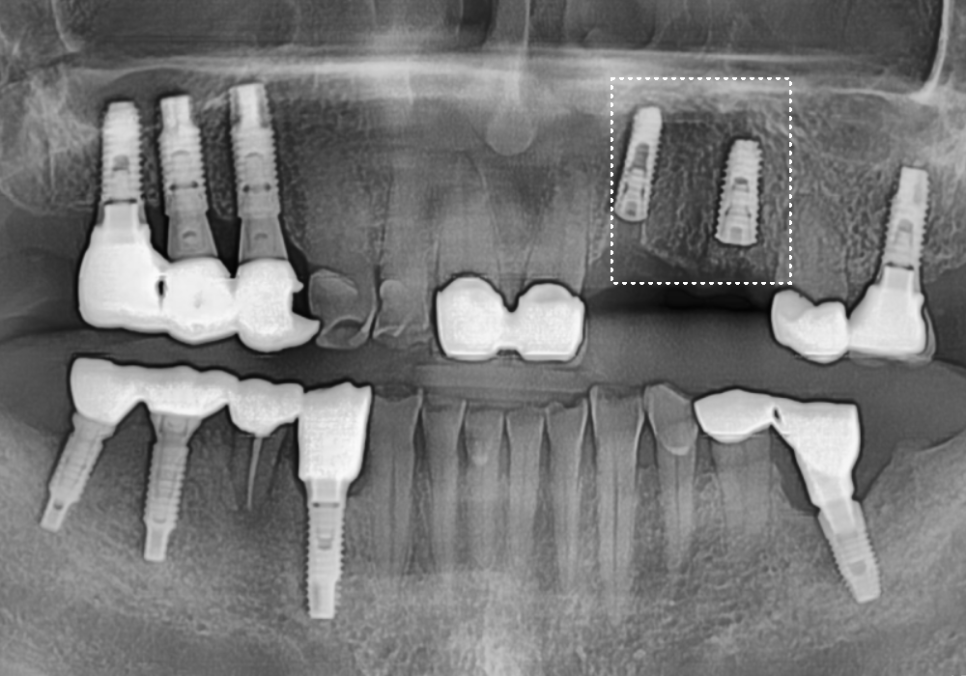 아스피린 복용 중인데 임플란트 수술, 가능할까요? 아스피린 얼마나 끊어야 하나요? 관련 이미지 6