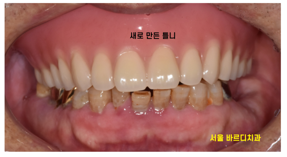 둔촌동 치과 80대 임플란트 가능한가요? 관련 이미지 8