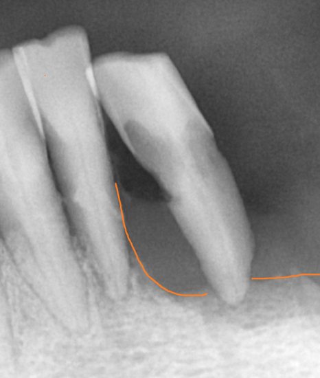 외국인 치과 진료 하악 전체 임플란트 7개 심어 12개 치아 만들기 관련 이미지 6