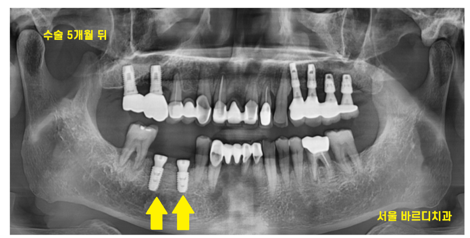 하남시청치과 치아 욱신거림 임플란트로 치료해드렸습니다. 관련 이미지 8