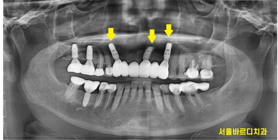 상일동 치과 충치로 인한 앞니 브릿지 파절 재건해보았습니다. 관련 이미지 1