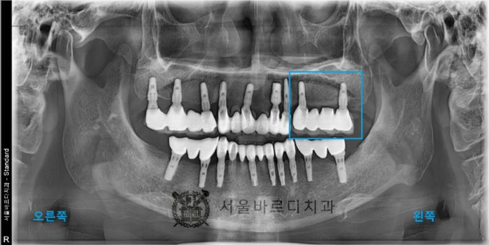 상일동역치과 서울바르디치과 무절개 네비게이션 임플란트 치료증례 #5 관련 이미지 6