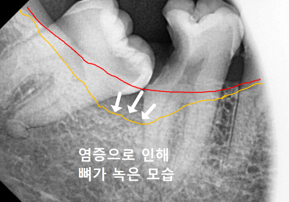 수평 매복 사랑니, 옆으로 누운 사랑니 때문에 멀쩡한 어금니까지 뽑은 사연 관련 이미지 6