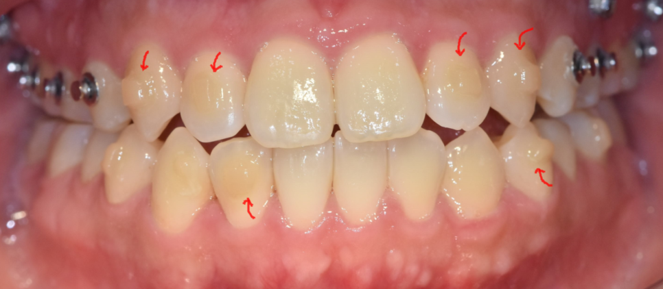 자가결찰 브라켓 빠르게 끝내고 통증은 줄여서 관련 이미지 5