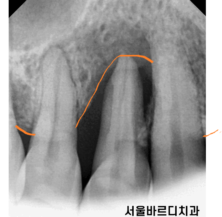 상일동역 치과 잇몸 뼈 녹음 임플란트 케이스 관련 이미지 1