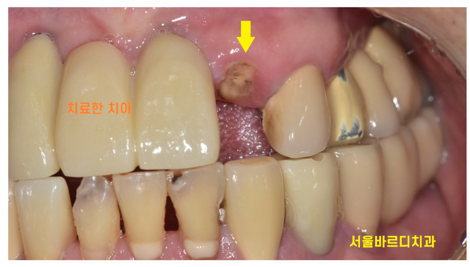상일동역 치과 부러진 앞니 임플란트로 복구하기 프로젝트 관련 이미지 10